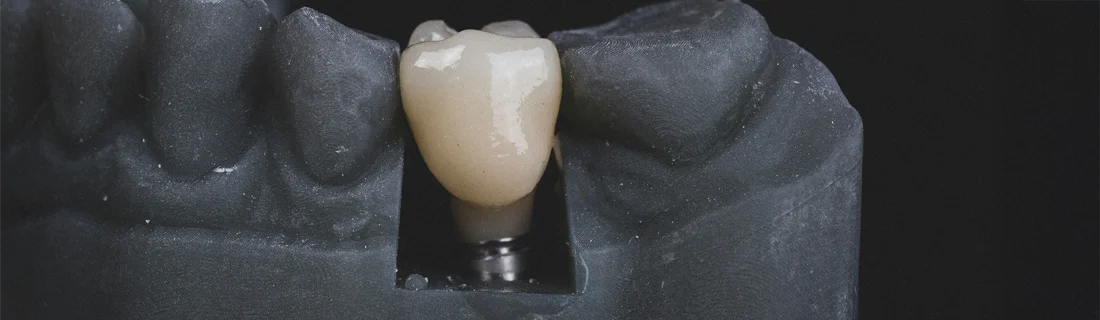 FC – Dental Implants at Torrance Dental Center FC – Dental Implants at Torrance Dental Center