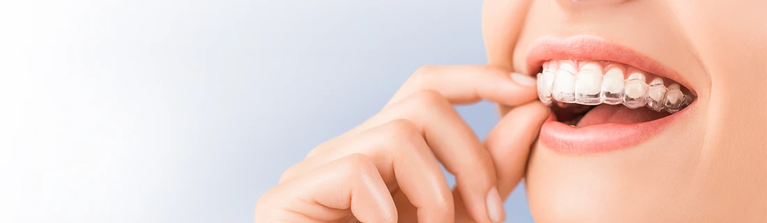 Clear Aligners in Torrance CA Clear Aligners in Torrance CA